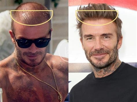 David Beckham Hair Transplant - Hair Loss & Technical Analysis