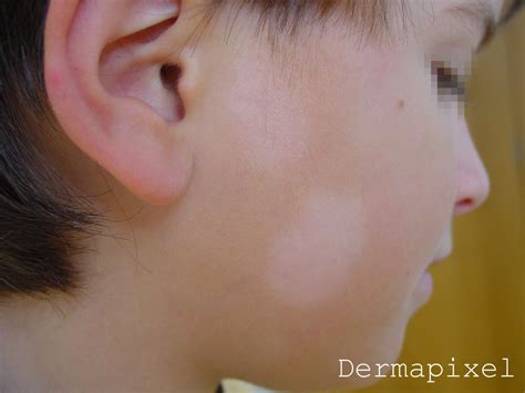 Dermapixel: Manchas blancas en la cara