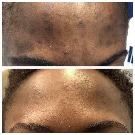 African American Hyperpigmentation Before and After St. Louis