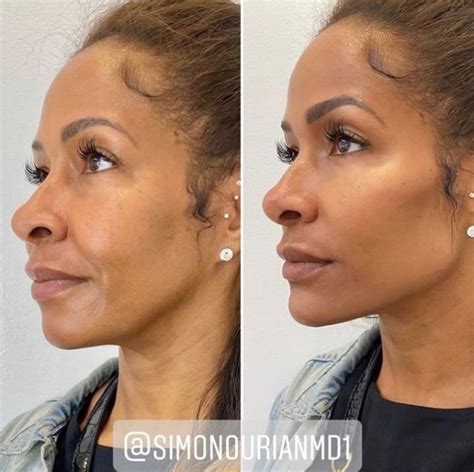 Facial Contouring Before and After Photo Gallery | Epione