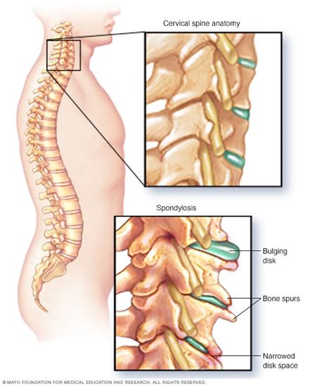 Cervical spondylosis - Mayo Clinic