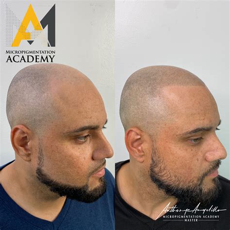 scalp micropigmentation training near me - lasker-alpheaus