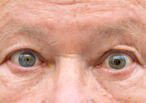 Understanding Dilated Pupils: Causes & Treatment