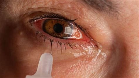 What is Eye Flu or Conjunctivitis | Causes, Treatment & Prevention