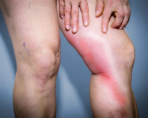 What is Phlebitis? Treatment and Symptoms for Thrombophlebitis ...