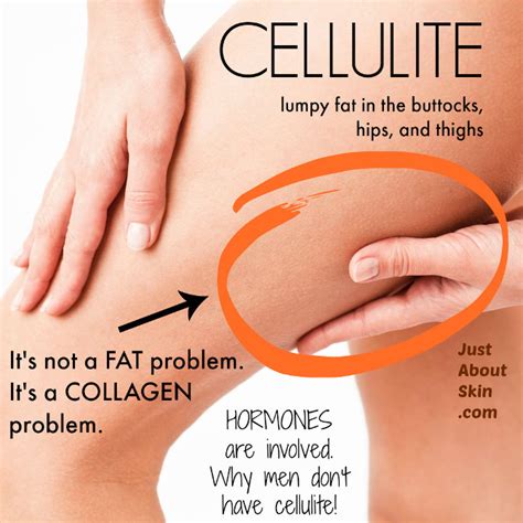 What Causes Cellulite and How Do You Treat It? - Just About Skin