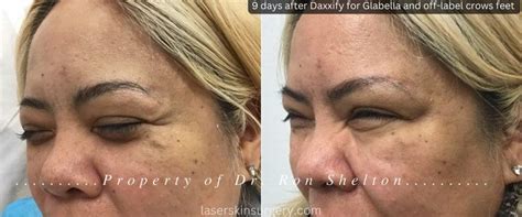 Daxxify vs Botox Cosmetic to reduce forehead frown lines in NYC