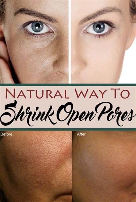 Try these natural remedies to shrink open pore on your face – Surreal ...