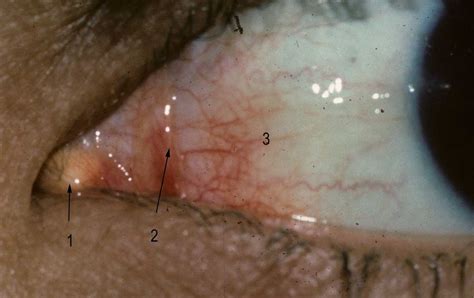 ANATOMY OF THE HUMAN EYE: Conjunctiva (answers)