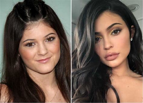 Kylie Jenner | Kylie jenner lips, Kylie jenner nose, Plastic surgery