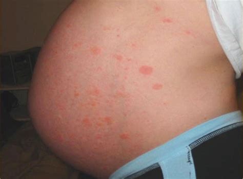 PUPPP rash in pregnancy: Natural treatments and prevention