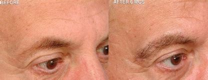 Eyebrow Transplant – Costs, For Men, Women, Before and After Photos ...