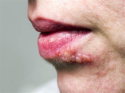 Shingles Symptoms On Face