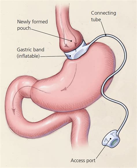 Gastric Sleeve Reviews, Surgery Complications, Recovery Time and Diet