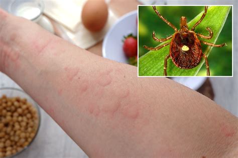 Incurable meat allergy from tick bite ‘turned my life upside down’: NJ man