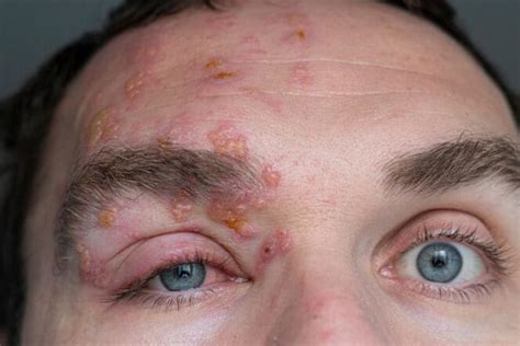 Shingles on the Face: Symptoms, Causes, and Treatments | MyVision.org