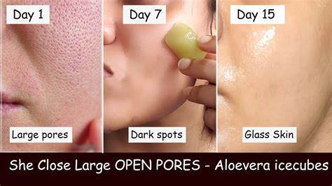 She rubs Aloevera ice cubes Daily & Closed LARGE OPEN PORES | Damaged ...