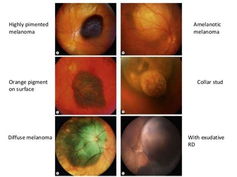 Choroidal melanoma