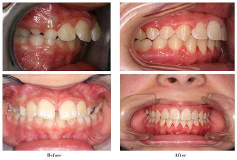 Invisalign Before And After Crowding