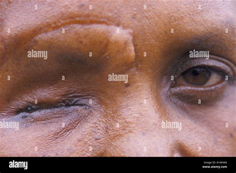 GENOCIDE SURVIVOR CHRISTINE WHOSE EYE WAS GOUGED OUT .1994 Stock Photo ...