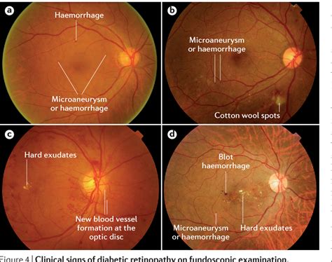 Diabetic retinopathy | Semantic Scholar