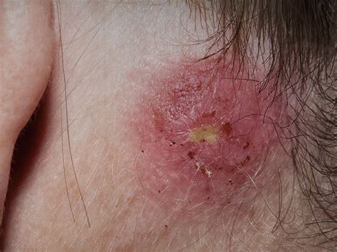 Staph infection: Types, symptoms, causes, treatments