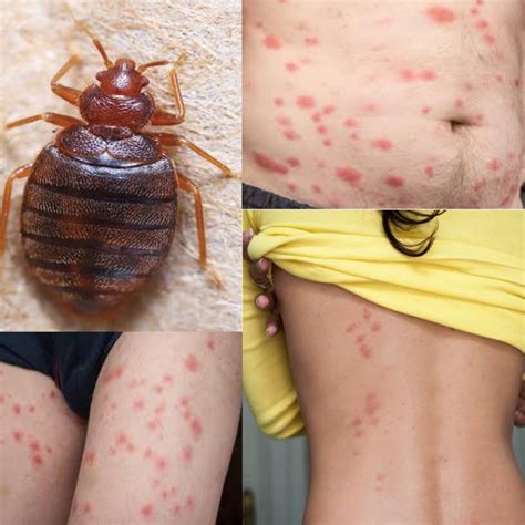 Bed Bug Bites Look Like On Humans