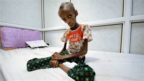 Images of Starving People in Yemen Help Show the Horrors of War - ABC News