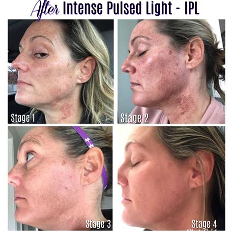 Dramatic Improvement In Sun Spots And Redness With IPL – Charmed Medispa