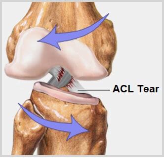 ACL Knee Injury: Causes, Symptoms & Treatment - Knee Pain Explained (2022)