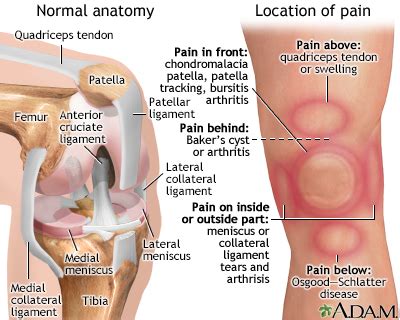 HIE Multimedia - Knee pain