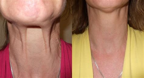 Wrinkle Treatment Before and After: Botox, Dermal Fillers