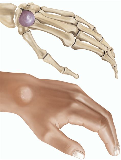 Excision of a ganglion | healthdirect