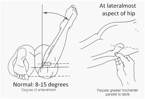 Femoral Anteversion test (Craig’s test) | Epomedicine