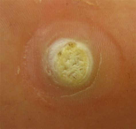 Plantar wart - Wikipedia