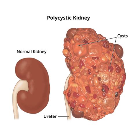 Polycystic Kidney Disease (PKD) - NIDDK