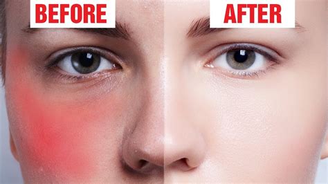 How To Get Rid Of Redness On Your Face Without Makeup - Mugeek Vidalondon