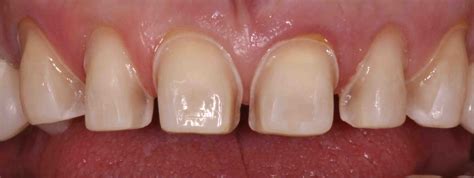 Anterior Veneer Prep for Closing Black Triangles - Lee Ann Brady, DMD's ...