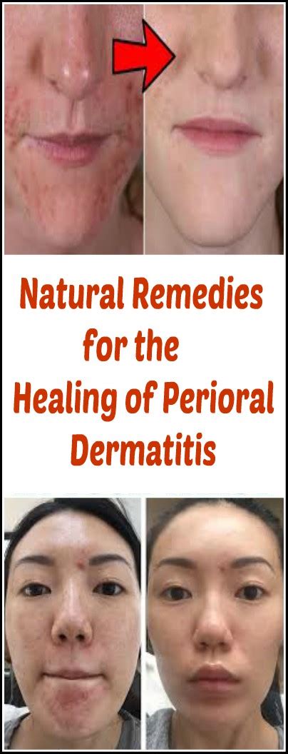 Natural Remedies for the Healing of Perioral Dermatitis