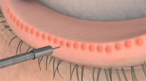 Meibomian Gland Dysfunction - Dr Lynette Venter | Ophthalmologist | Eye ...