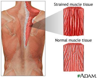 Muscular Inflammation