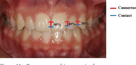 Esthetic considerations in interdental papilla: remediation and ...