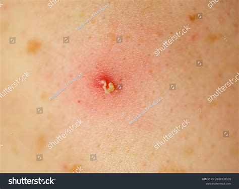 245 Pimple Bursting Images, Stock Photos & Vectors | Shutterstock