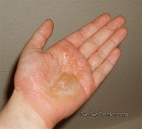 Dyshidrotic Eczema – Pictures, Causes, Home Remedies, Treatment ...