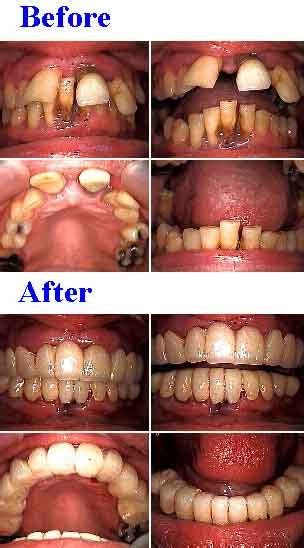 Periodontist offers Gum Surgery for Gum Disease.