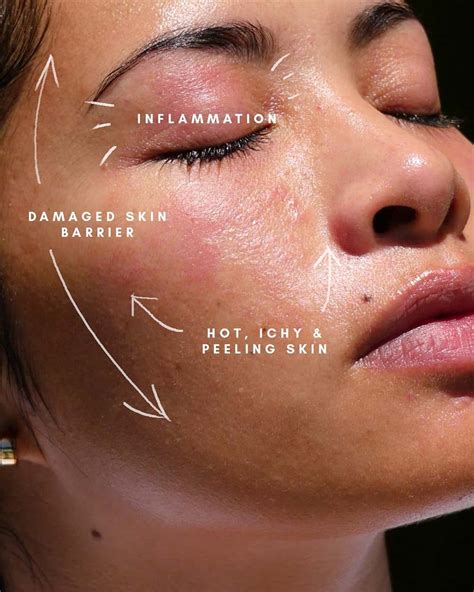 What Leads to a Damaged Skin Barrier + Ways to Fix It