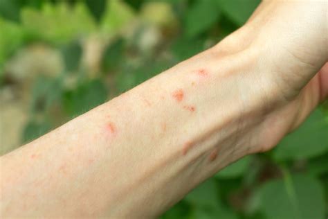 Poison Sumac Rash On Hands