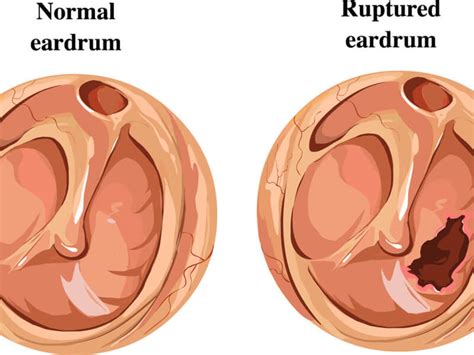 What You Need To Know About Eardrum Repair