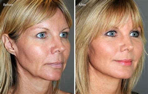 Laser Skin Tightening: How It Works, Results, Risks and Cost | Laser ...