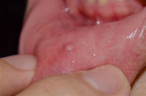 Mucocele (Mucous Cyst) Types, Symptoms, Causes, Diagnosis, & Treatment ...